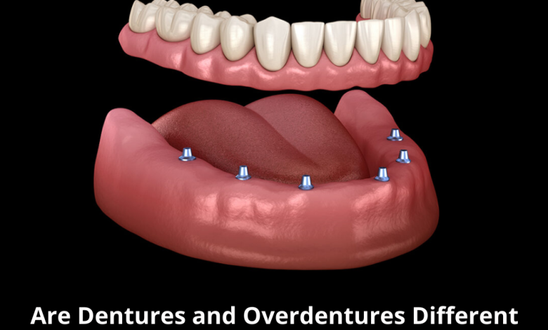 Are dentures and overdentures different treatments