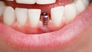 Photo of Ways To Introduce Dental Implant