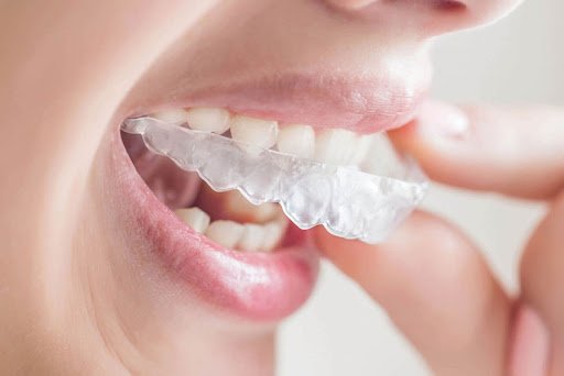 Important Facts That You Should Know About Clear Aligners