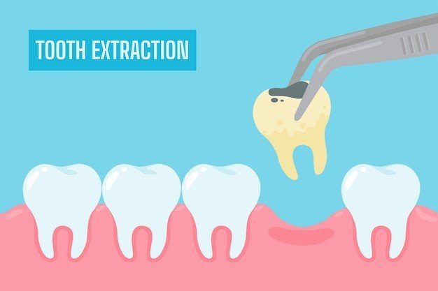 Tooth Extractions Aftercare