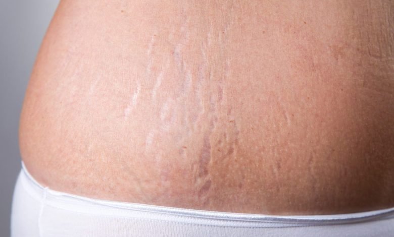 Skin stretch marks removal treatment