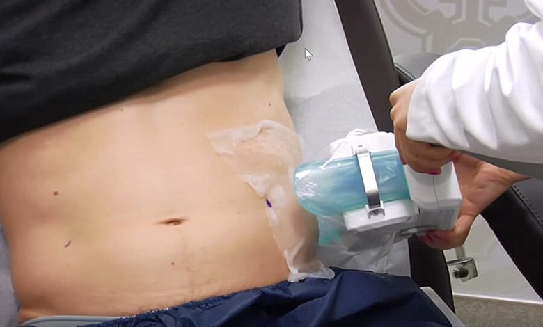 CoolSculpting